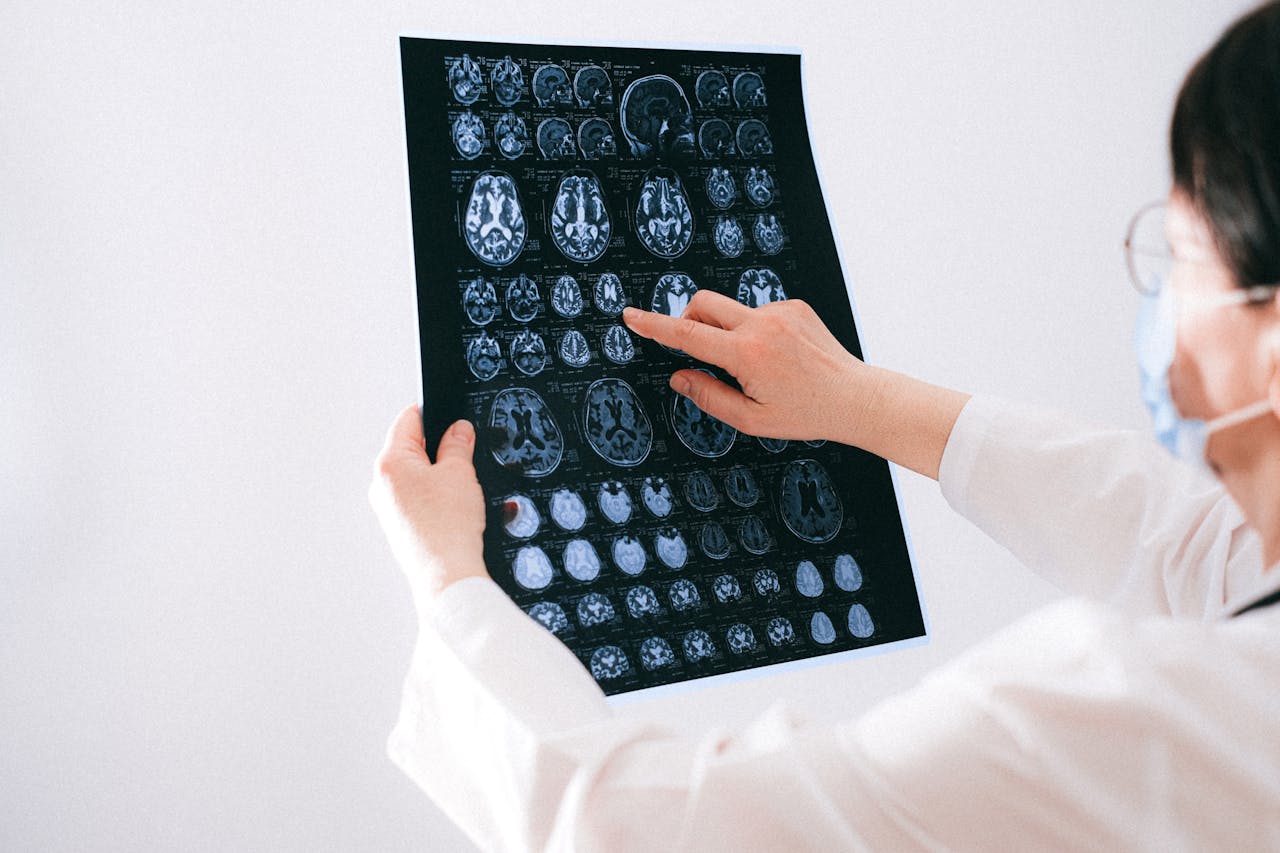The Long-Term Effects of Traumatic Brain Injuries from Seattle Car Accidents