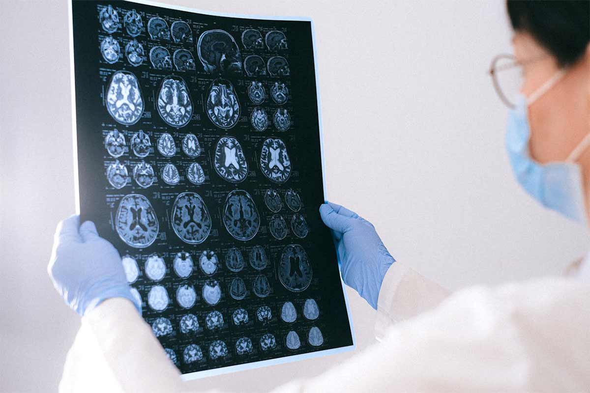 The Long-Term Effects of Traumatic Brain Injuries from Seattle Car Accidents